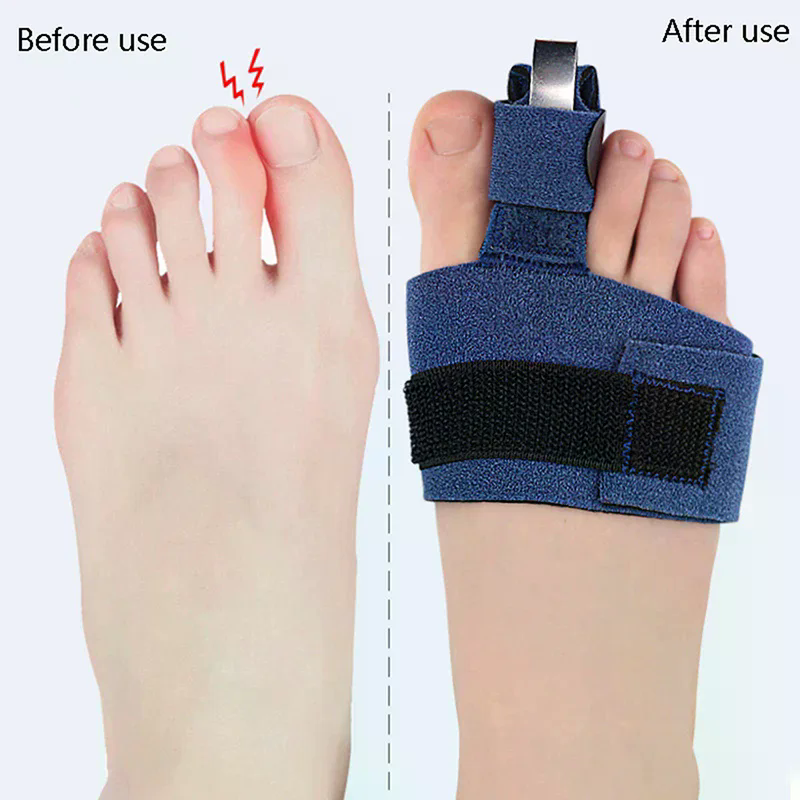 1Pcs Toe Corrector Toe Fractur - Ankle Brace Sock avaliação e preço